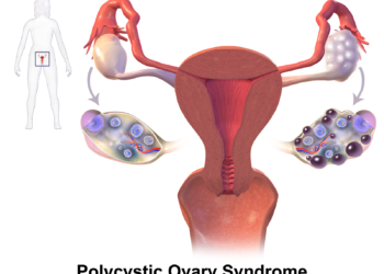 PCOS | A Beginners Article