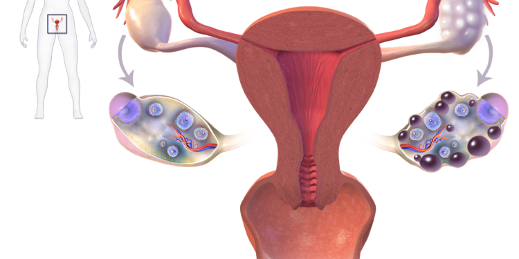 PCOS | A Beginners Article