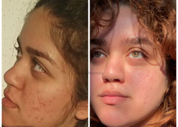 Acne | Things I Did To Get Rid Of It