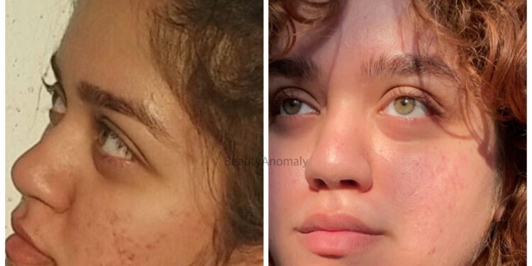 Acne | Things I Did To Get Rid Of It